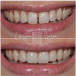 Invisalign before & after